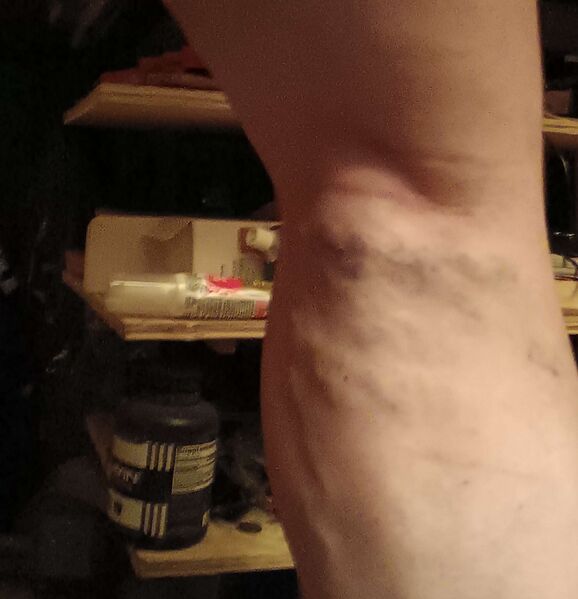 File:Tonys varicose veins.jpg